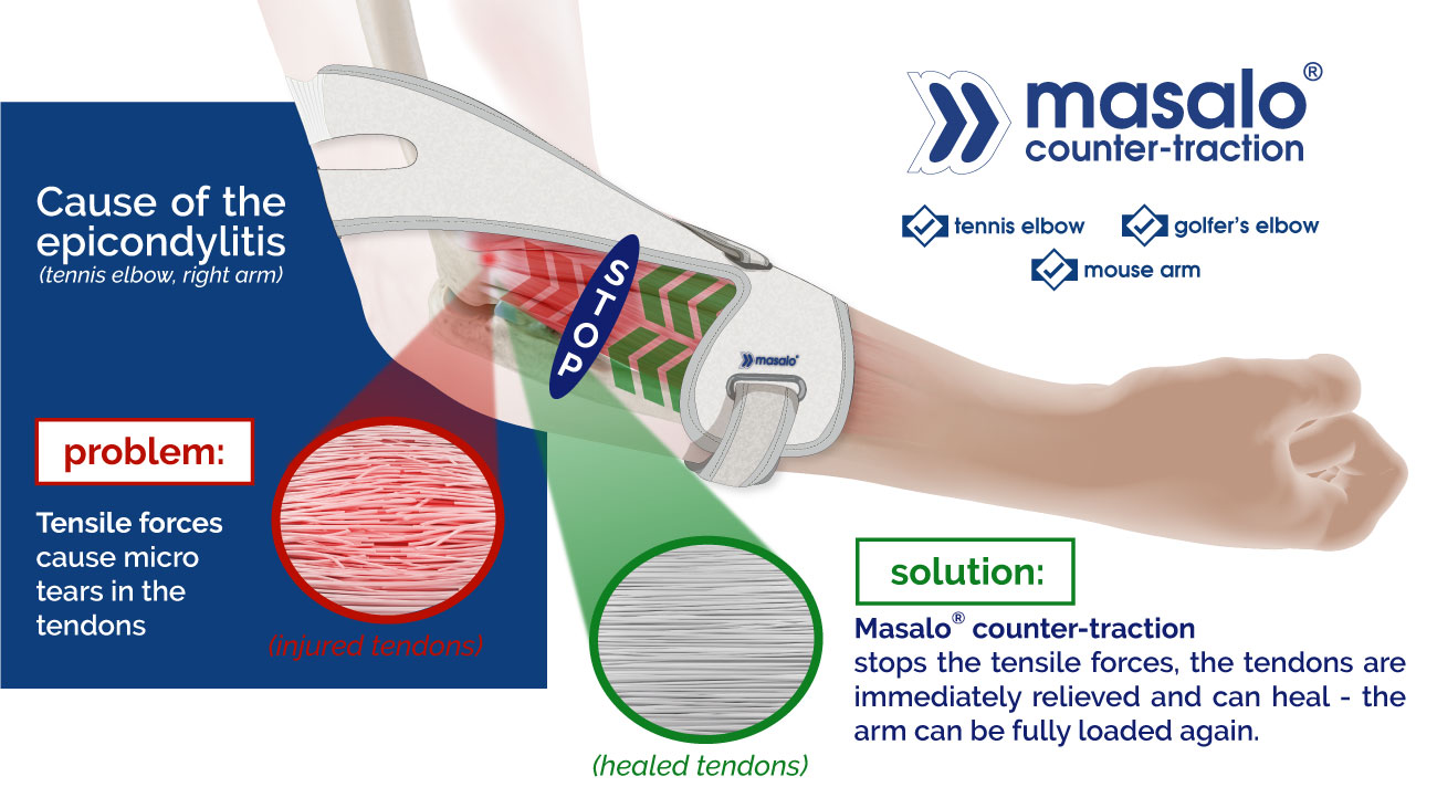 Diagram of Masalo cuff countertraction principle against tennis elbow, golfer's elbow, mouse elbow, epicondylitis