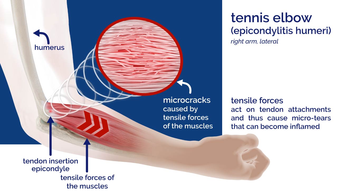 Diagram cause of epicondylitis, tennis elbow, golfer's elbow of Masalo UK.