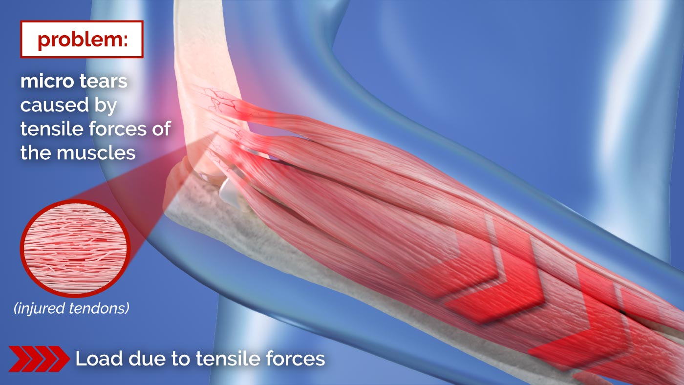 Illustration how tensile forces cause the epicondylitis
