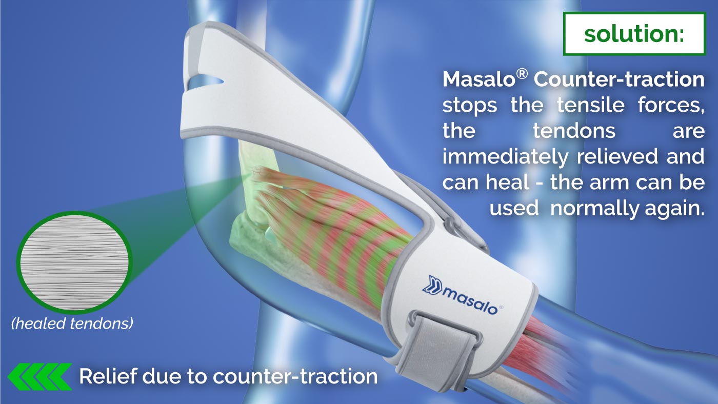 Operating principle of the Masalo Cuff against tennis wlbow, golfer's elbow